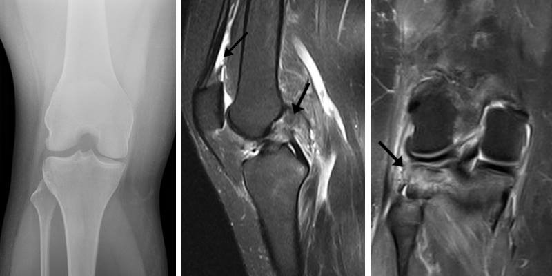 Røntgen og MR-scanning af knæ